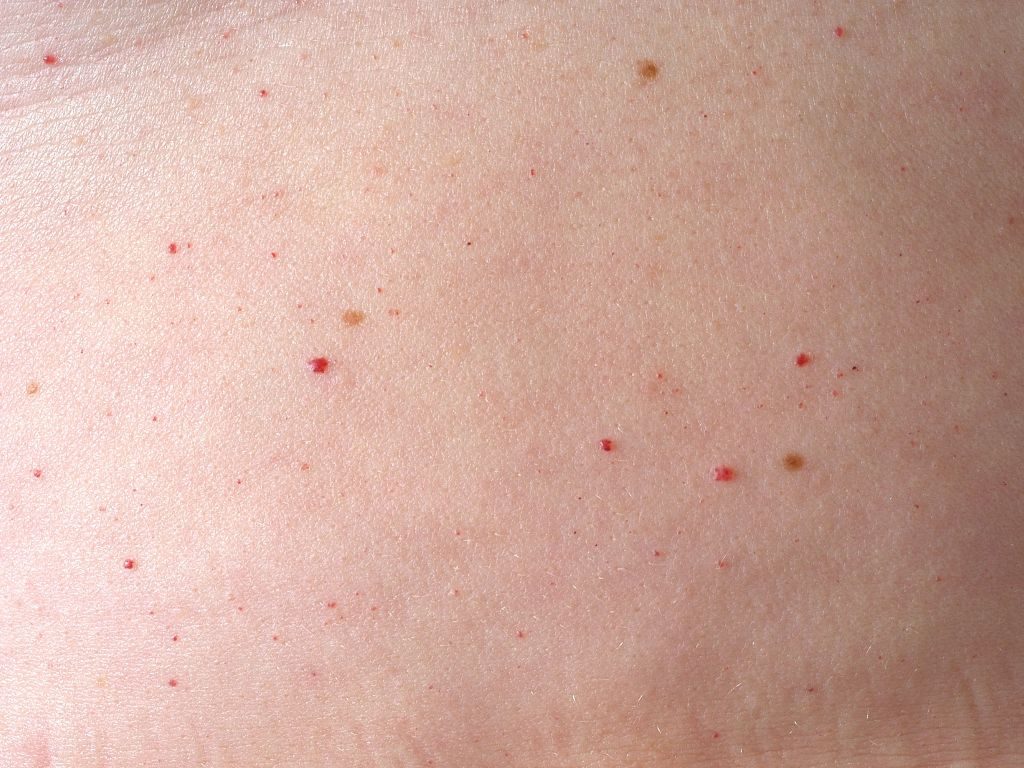 Comprendre les causes du point rouge sur la peau et comment le traiter efficacement